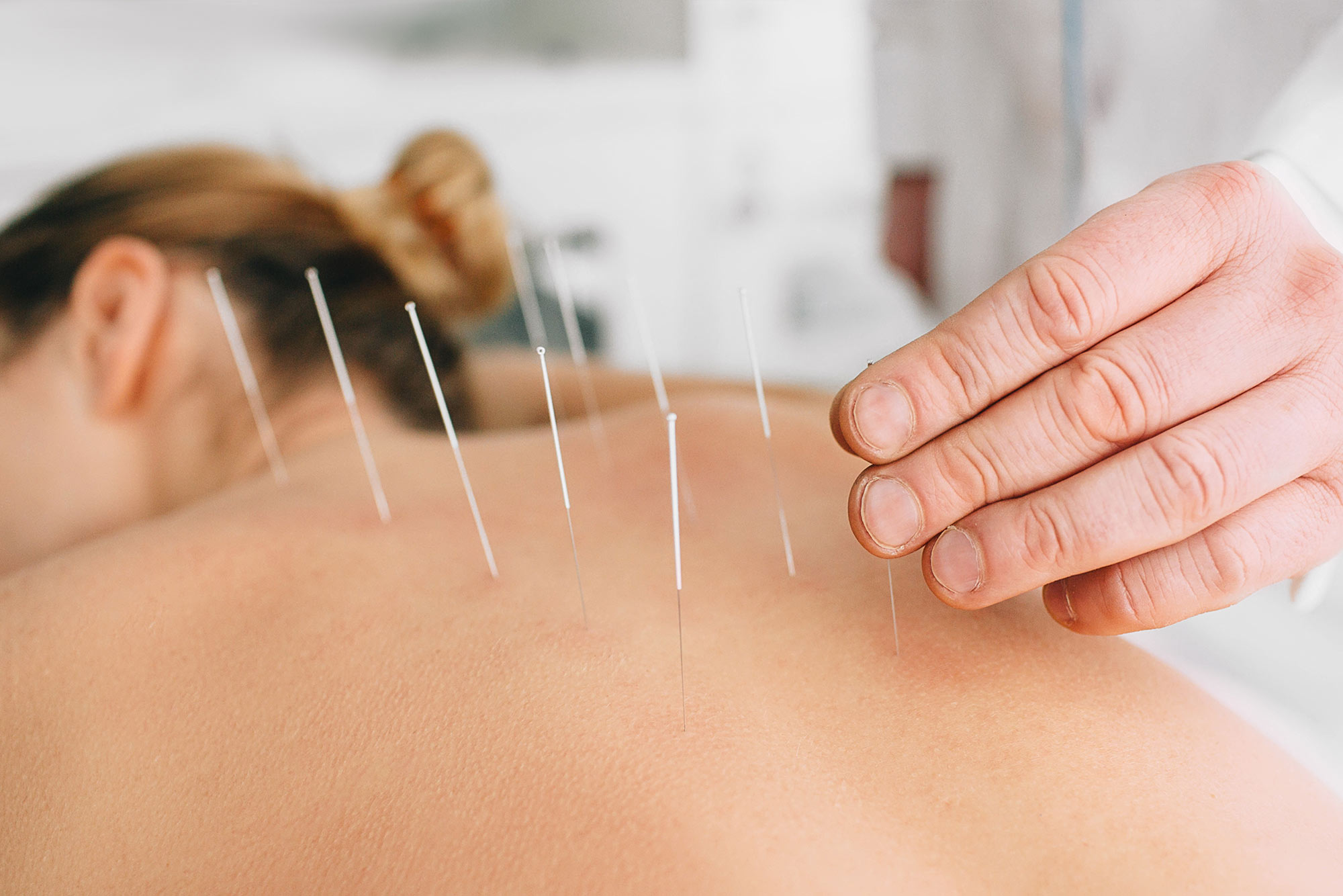 Acupuncturist placing acupuncture needles in woman's back